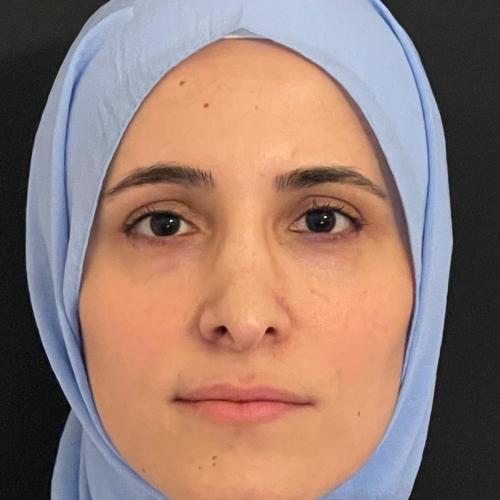Rhinofiller Before / After photo